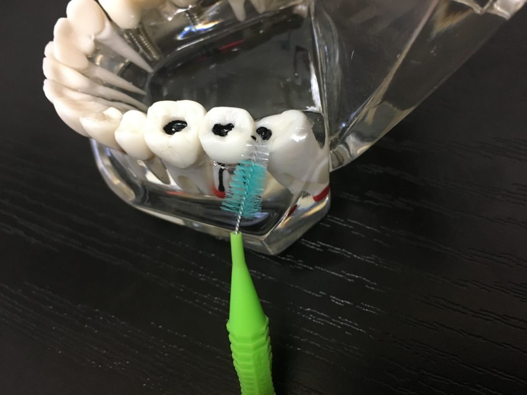 歯間ブラシで歯周病をチェックする方法